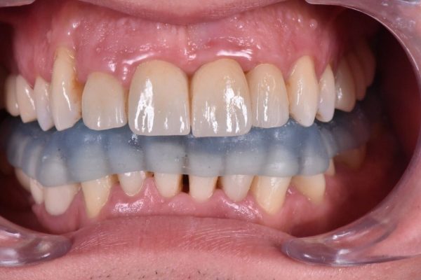 Senertek Splint - Image 2